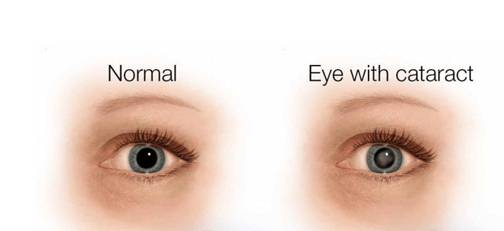Cataract Eyes